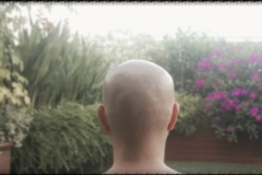 I lost all my hair within 6 months, after alopecia areata strikes